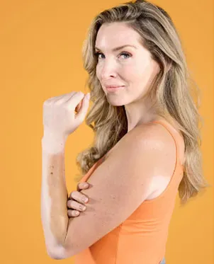 Frau mit Vitiligo im Gesicht und auf den Armen steht vor einem orangenen Hintergrund mit orangenen Trägershirt