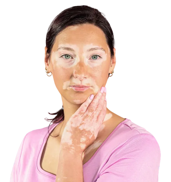 Frau mit Vitiligo Weissfleckenkrankheit im Gesicht und auf den Händen, heller Hauttyp mit dunklen Haaren.