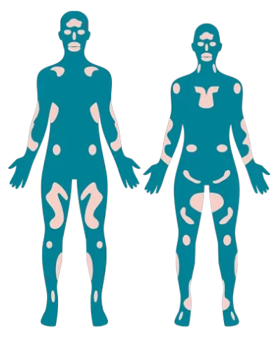 Incyte llustration Nicht-Segmentale-Vitiligo Weissfleckenkrankheit Illustration von zwei Menschen mit nicht-segmentaler Vitiligo. Die Flecken breiten sich spiegelgleich auf beiden Körperseiten gleichermaßen aus.